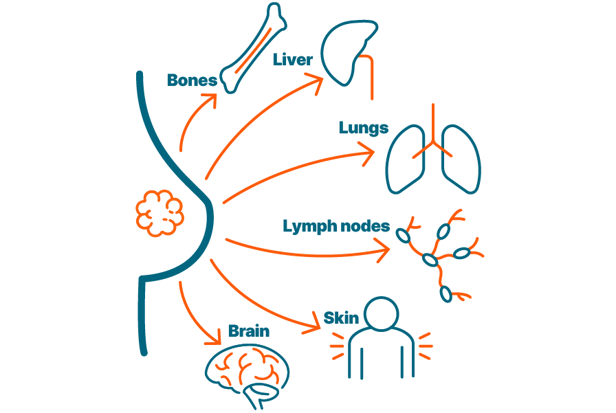 Common sites of breast cancer metastases are shown. Bones, liver, lungs, lymph nodes, skin, and brain.